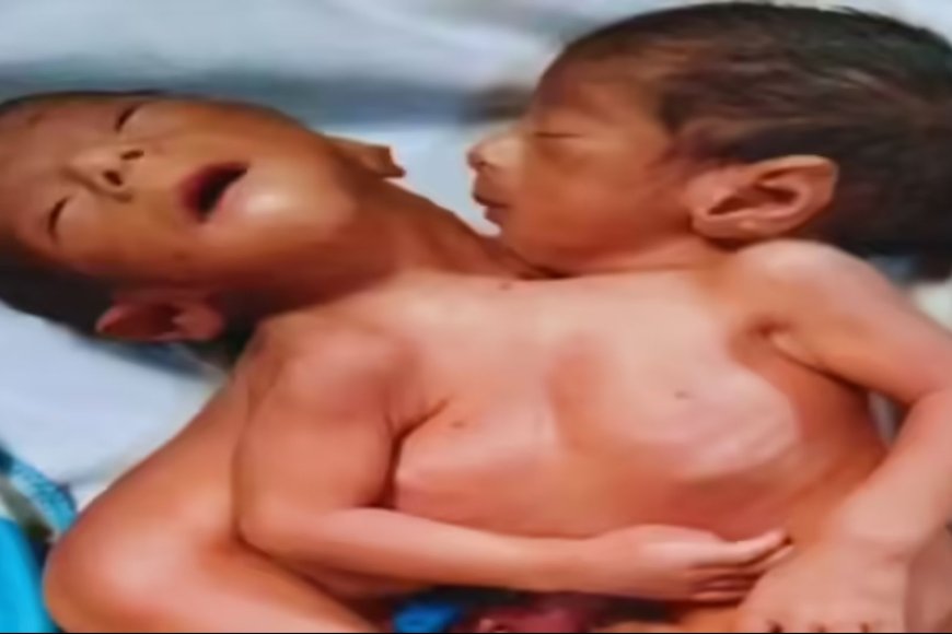 अलीगढ़ में चौंकाने वाला मामला: दो सिर वाले जुड़वां बच्चों को जन्म, सदमे में मां की मौत