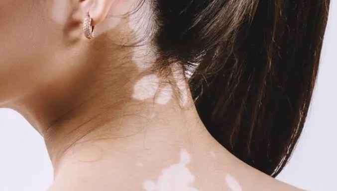 White spots (leucoderma) – a detailed medical analysis on causes and treatment