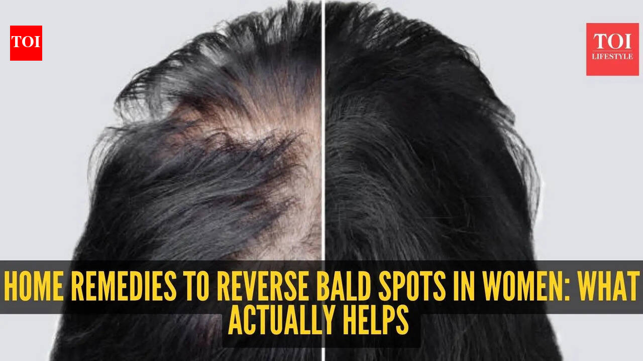 Alopecia Areata Treatment: Home Remedies to Cure Baldness in Women
